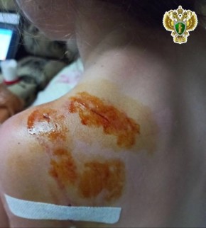 В Коноше по иску прокурора суд принял решение взыскать моральный вред в пользу несовершеннолетней, причиненного укусом собаки