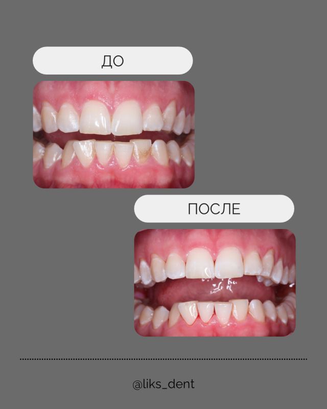 Зачем нужна профессиональная гигиена полости рта?